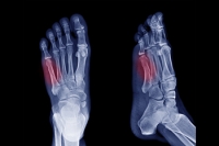 Causes and Risks of Jones Fractures