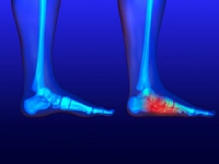 Three Types of Flat Feet